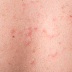 skin with little red bumps that are folliculitis